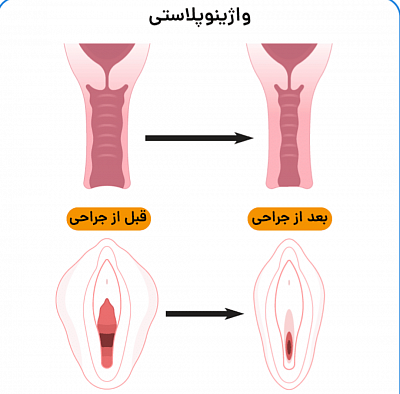 خرید تنگ کننده واژن گیاهی,خریدشیاف تنگ کننده واژن ازداروخانه, خریدژل تنگ کننده دیجی کالا,خریدقرص تنگ کننده واژن,
